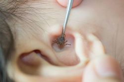 Trong nhà nuôi nhiều thú cưng, bọ chét ký sinh trên màng nhĩ bé gái 2 tuổi