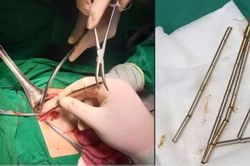 Phẫu thuật lấy 25 viên nam châm trong đường tiêu hóa bệnh nhi