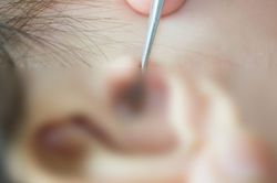 Phát hiện bọ chét ký sinh trong màng nhĩ bé gái 2 tuổi