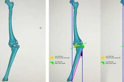 Điều trị thành công bệnh Blount biến dạng chi dưới bằng công nghệ hiện đại