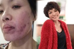 Nữ diễn viên bị tát bầm mặt