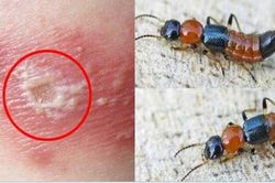 Cách phân biệt kiến ba khoang và zona thần kinh, tránh điều trị sai gây biến chứng