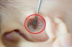 Bé 2 tuổi đau tai bất thường, bố mẹ 'sốc' khi bác sĩ gắp ra thứ 'đáng sợ' bên trong