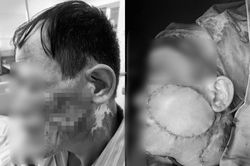 Từ nốt nhỏ vùng má, người đàn ông phát hiện ung thư gây biến dạng khuôn mặt