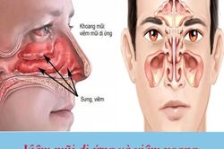 Nghẹt mũi mùa hè: Cảnh giác nhầm lẫn giữa dị ứng và viêm xoang