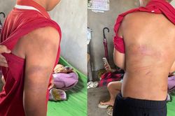 Công an vào cuộc xác minh vụ cháu bé đầy vết bầm tím trên cơ thể