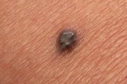 Người đàn ông suýt chết vì... một nốt ruồi
