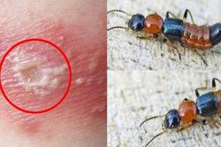Bác sĩ cảnh báo không chủ quan với tổn thương do kiến ba khoang gây ra