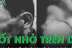 Chủ quan với nốt nhỏ trên da, người đàn ông nhiều lần phẫu thuật ung thư xâm lấn tái phát