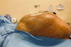 Phẫu thuật khối u buồng trứng gần 15kg cho nữ sinh 16 tuổi