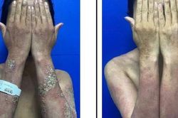 Người phụ nữ mắc vảy nến chi chít mụn mủ, kháng phác đồ điều trị truyền thống