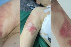 Người phụ nữ tố bị bỏng khi sử dụng dịch vụ tại spa ở Hà Nội