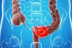 Từ polyp đến ung thư: Hành trình 10 năm có thể ngăn chặn