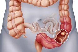 Người thân mắc ung thư tiêu hóa: Gia đình cần làm gì?