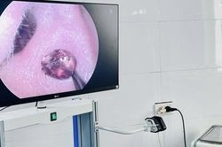 Đau nhức tai suốt một tuần, người phụ nữ tá hỏa vì 'vị khách lạ' trong tai