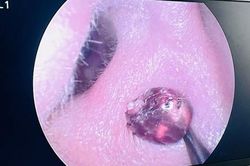 Đau tai đi khám, bệnh nhân hốt hoảng vì sinh vật ký sinh ẩn nấp