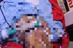 Bị bỏng nặng, mẹ đợi con thi xong tốt nghiệp THPT mới yên lòng nhắm mắt