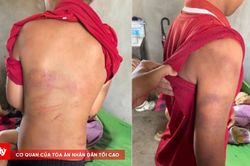 Diễn biến mới vụ cháu bé xuất hiện nhiều vết bầm tím trên cơ thể