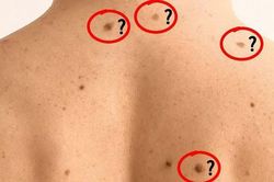 Nổi nhiều nốt ruồi là dấu hiệu ung thư?