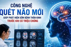 Công nghệ quét não mới giúp phát hiện sớm bệnh thần kinh trước khi có triệu chứng