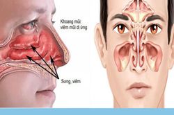 Thời tiết hè thất thường: Coi chừng nhầm lẫn giữa viêm mũi dị ứng và viêm xoang