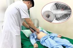 Nhổ răng tại nhà, bé trai suýt ngạt thở vì chiếc răng rơi vào phổi