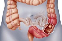 Nội soi định kỳ - 'Vũ khí số 1' trong cuộc chiến chống ung thư tiêu hóa