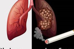Thuốc lá gây ra 90% các trường hợp ung thư phổi