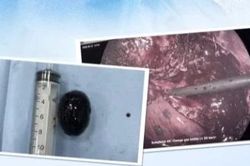 Người đ&agrave;n &ocirc;ng 70 tuổi nhập viện v&igrave; t&uacute;i mật hoại tử do sỏi