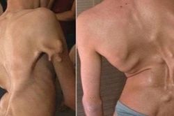 Bé gái 12 tuổi mắc hội chứng 'người hóa đá' cực hiếm, cả triệu người mới có một ca