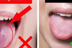 3 dấu hiệu trên lưỡi có thể cảnh báo gan đang gặp vấn đề nghiêm trọng