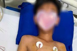 Cứu sống bé trai bị ong vò vẽ đốt 55 vết, sốc phản vệ nguy kịch