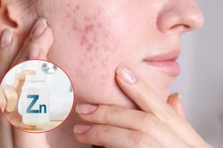 Muốn đẹp da, hết mụn thì đừng quên uống kẽm: 5 lợi ích cho làn da khiến nhiều người bất ngờ