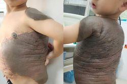 B&eacute; trai 7 tuổi mang chiếc 'mai r&ugrave;a' tr&ecirc;n lưng