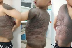 B&eacute; trai mang 'mai r&ugrave;a' suốt 7 năm lần đầu đứng thẳng