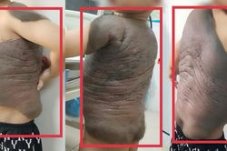 Bé trai mang khối u khổng lồ như 'mai rùa', lần đầu tiên đứng thẳng lưng sau 7 năm
