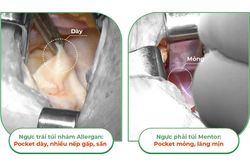 Khác nhau giữa túi ngực nhám và túi ngực trơn trên cùng 1 cơ thể