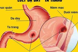 Những nguy cơ khi tự ý dùng meloxicam trị đau xương khớp