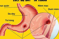 Những nguy cơ khi tự ý dùng meloxicam trị đau xương khớp