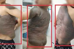 6 lần đại phẫu cắt bỏ khối u 'mai r&ugrave;a' nặng trĩu tr&ecirc;n lưng b&eacute; trai 7 tuổi
