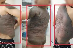 6 lần đại phẫu cắt bỏ khối u 'mai r&ugrave;a' nặng trĩu tr&ecirc;n lưng b&eacute; trai 7 tuổi