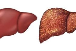 Ph&aacute;t hiện bệnh xơ gan qua c&aacute;c dấu hiệu sớm
