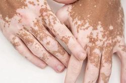 Bạch biến không lây nhưng dễ bị hiểu nhầm
