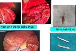 Liên tiếp 2 trường hợp bệnh nhi viêm phúc mạc do mảnh xương lợn đâm thủng ruột non