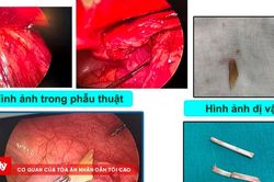 Trẻ 48 tháng tuổi bị xương lợn đâm thủng ruột