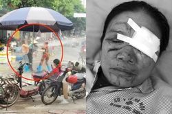 Tình hình của người phụ nữ bị chủ quán hải sản xịt nước chảy máu mắt