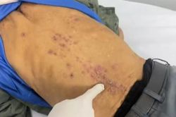 Người đàn ông phát hiện mắc cùng lúc hai loại ký sinh trùng