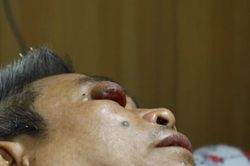 Người đàn ông 4 năm tự chữa u mắt bằng thuốc nam, ung thư lan đến hạch ổ bụng