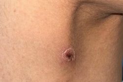 Một vết đốt khô, không đau khiến người phụ nữ lâm bạo bệnh