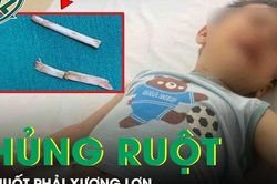 Hai trẻ bị thủng ruột, viêm phúc mạc do nuốt phải xương lợn